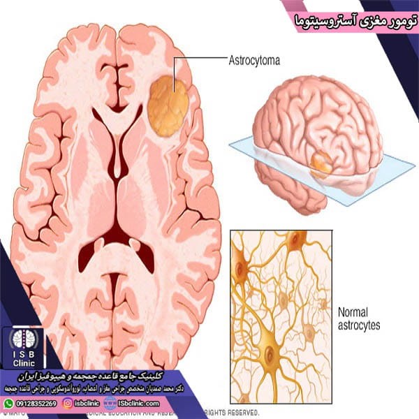 تومور مغزی آستروسیتوما چیست