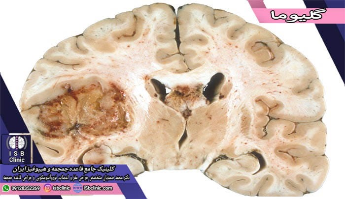 تومور گلیوم مغز