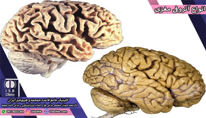 انواع آتروفی مغزی
