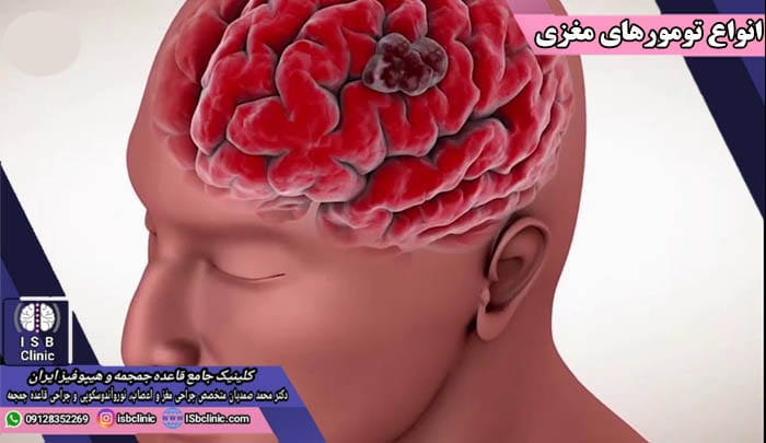 انواع تومورهای مغزی