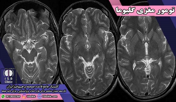 طول عمر بیماران تومور مغزی گلیوما