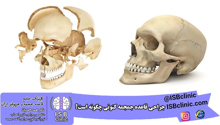 چه جراحانی می توانند جراحی قاعده جمجمه را انجام دهند؟