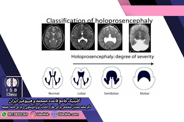 علل و میزان شیوع هولوپروزنسفالی