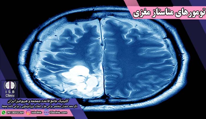 تشخیص سرطان متاستاتیک مغزی
