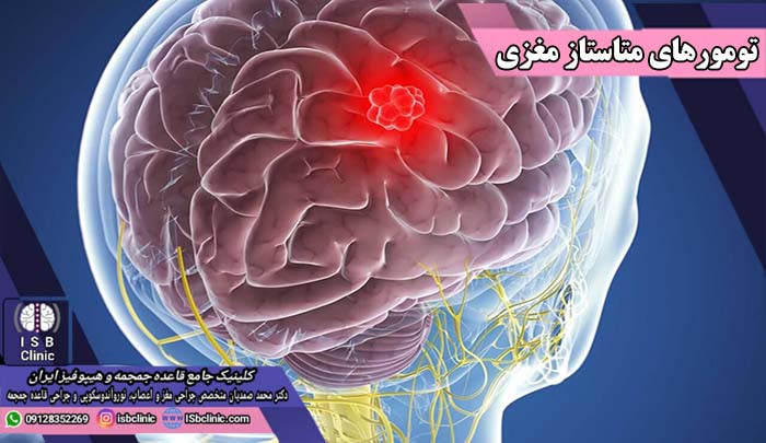 متاستاز سرطان تیروئید به مغز