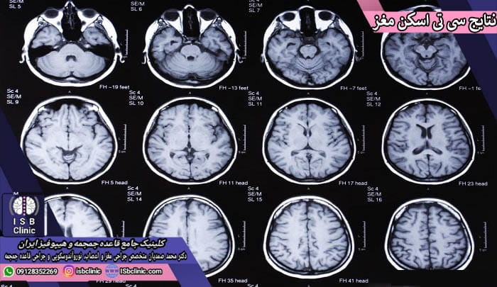 نتایج غیرعادی در سی تی اسکن مغز و اعصاب