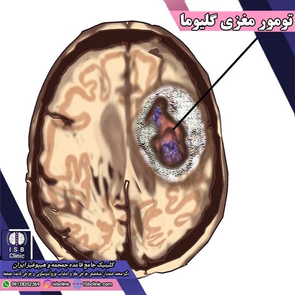 تومور مغزی گلیوما چیست و چگونه درمان می شود؟
