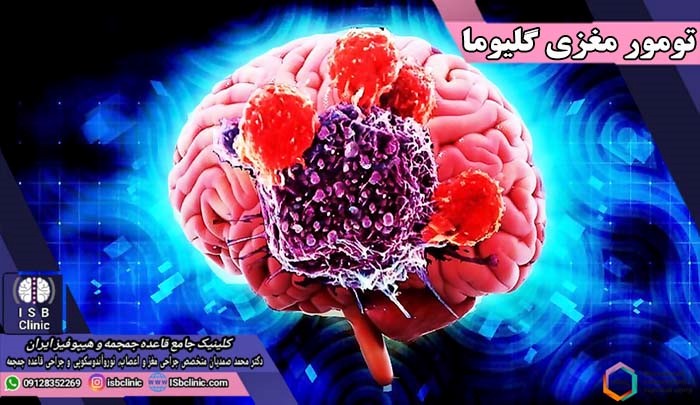تومور مغزی گلیوما چیست؟