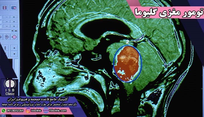 جراحی تومور مغزی گلیوما