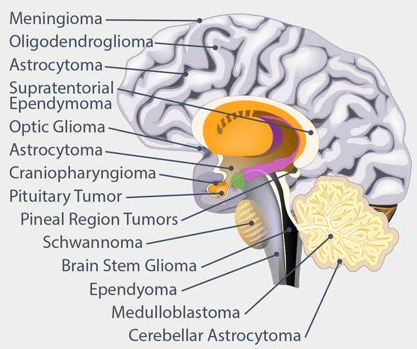 انواع تومور مغزی