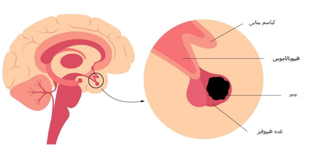 تومور هیپوفیز