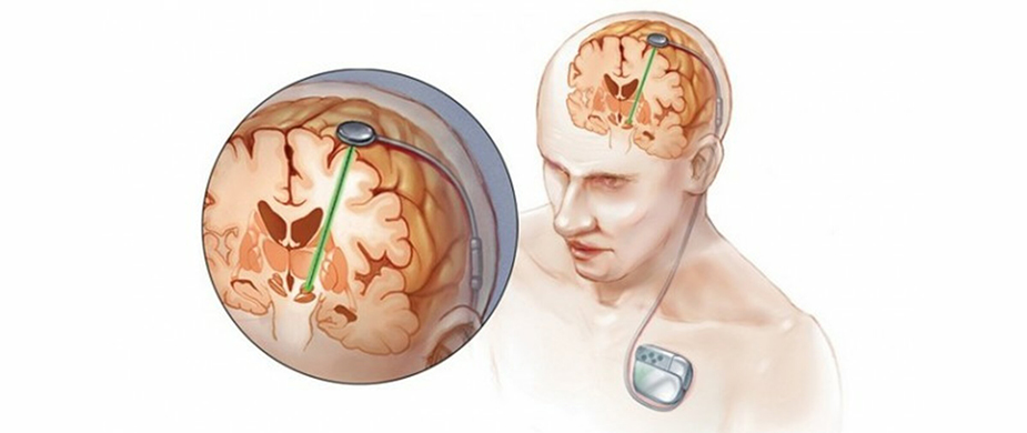تحریک عمقی مغز (dbs)