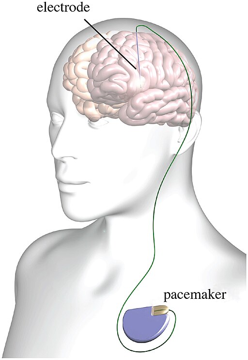 تحریک عمقی مغز (dbs)