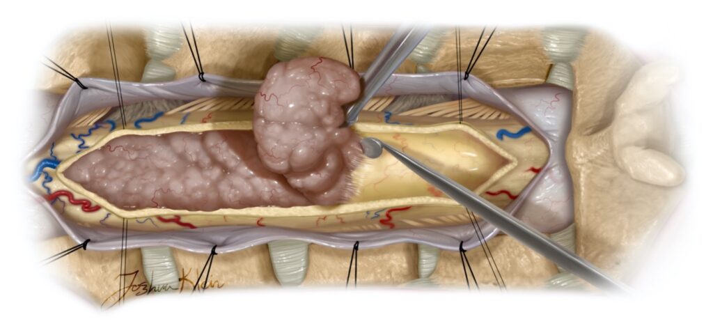 تومور نخاعی چیست؟