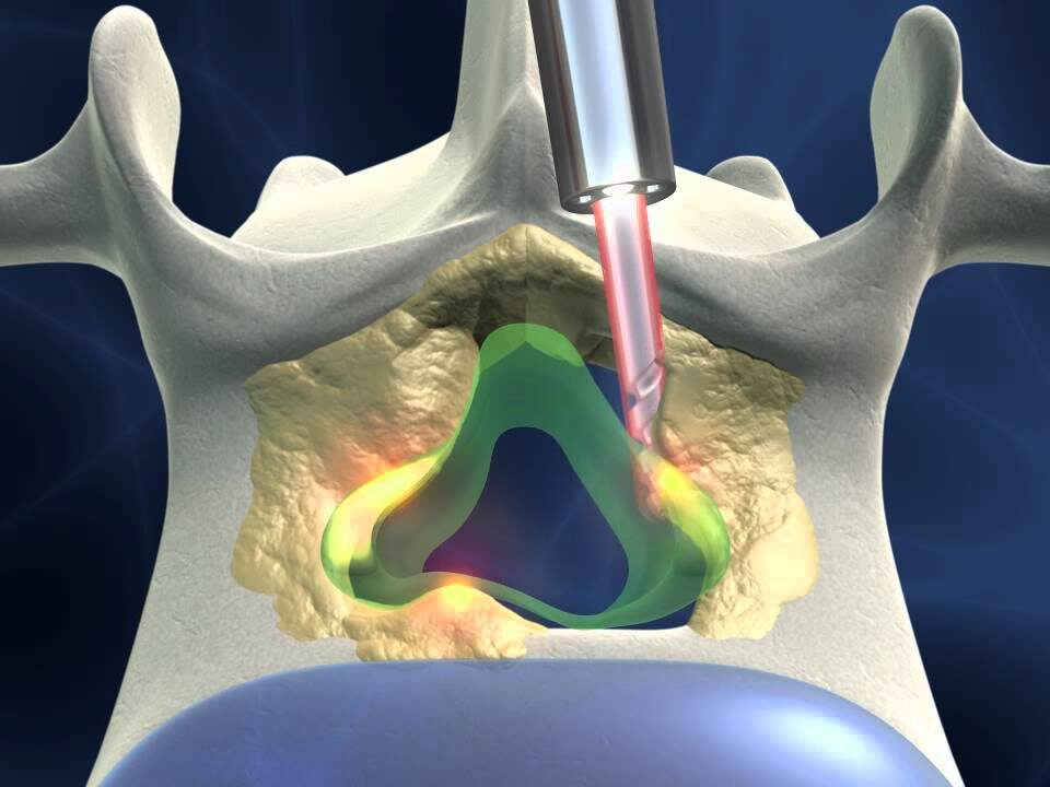 جراحی لیزری دیسک کمر